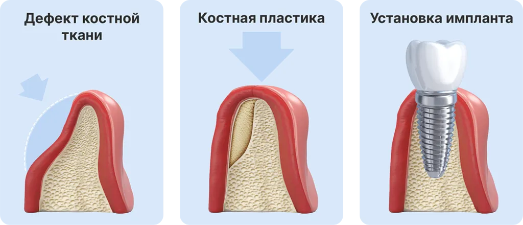 Этапы проведения косной пластики при имплантации зуба